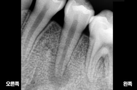신경치료 전후사례